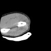 SPORK, NICO - 22.03.1976 - 02.08.2022 - CT obere Extremität - 17:56:57